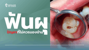 dentalland hatyai-ฟันผุ