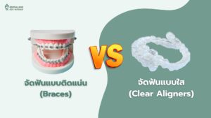 จัดฟันแบบติดแน่น/จัดฟันแบบใส