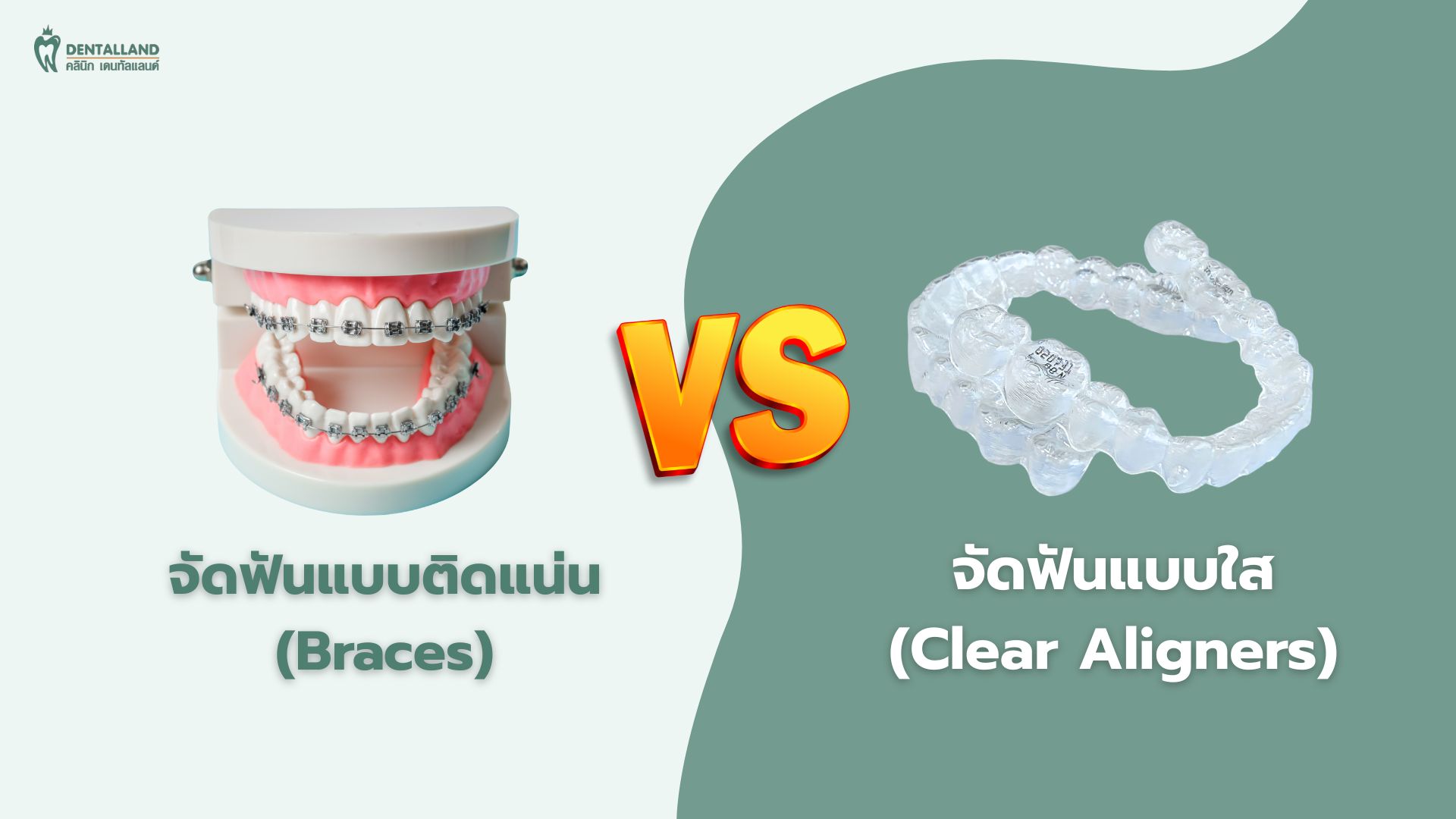 จัดฟันแบบติดแน่น/จัดฟันแบบใส